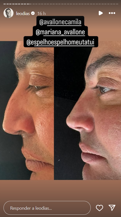 leo dias rinoplastia
