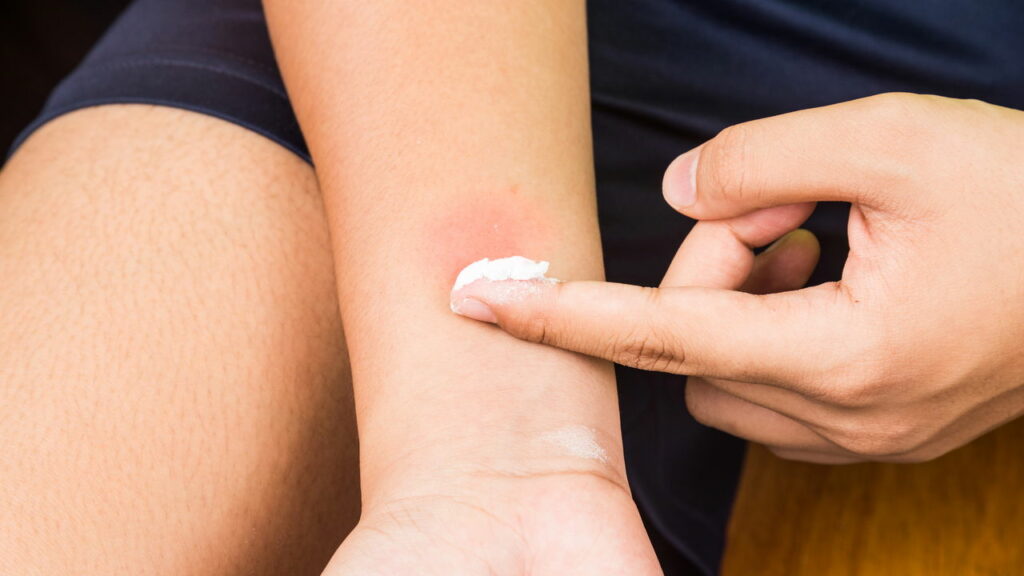 Como proteger-se das picadas de mosquitos e aliviar o desconforto