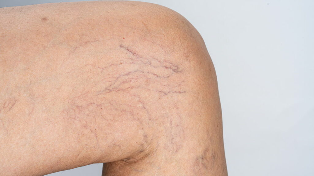 Como combater as varizes de forma natural