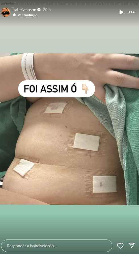 Isabel Veloso mostra resultados da nova cirurgia