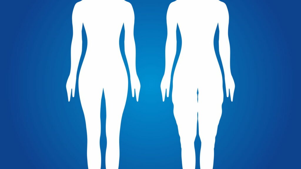 Essa condição crônica pode ser confundida com obesidade, saiba mais!