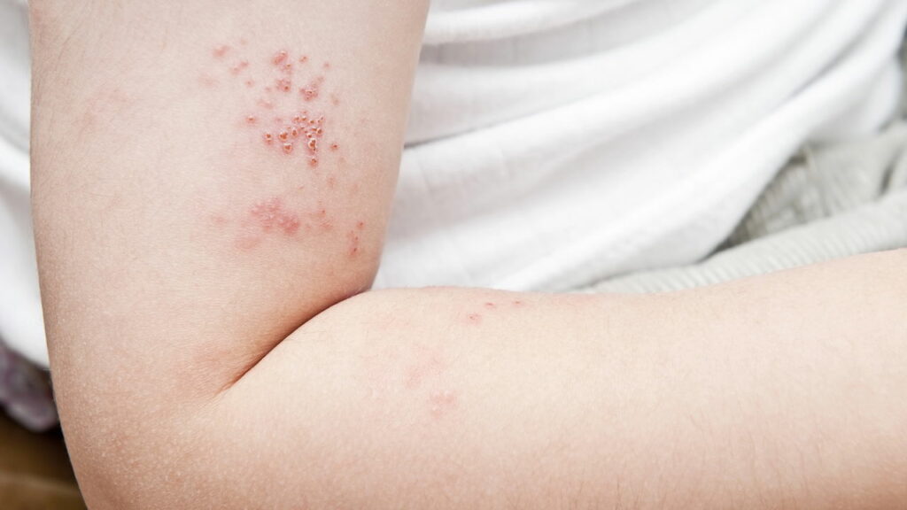 Quais são os sintomas e como se proteger do herpes zoster