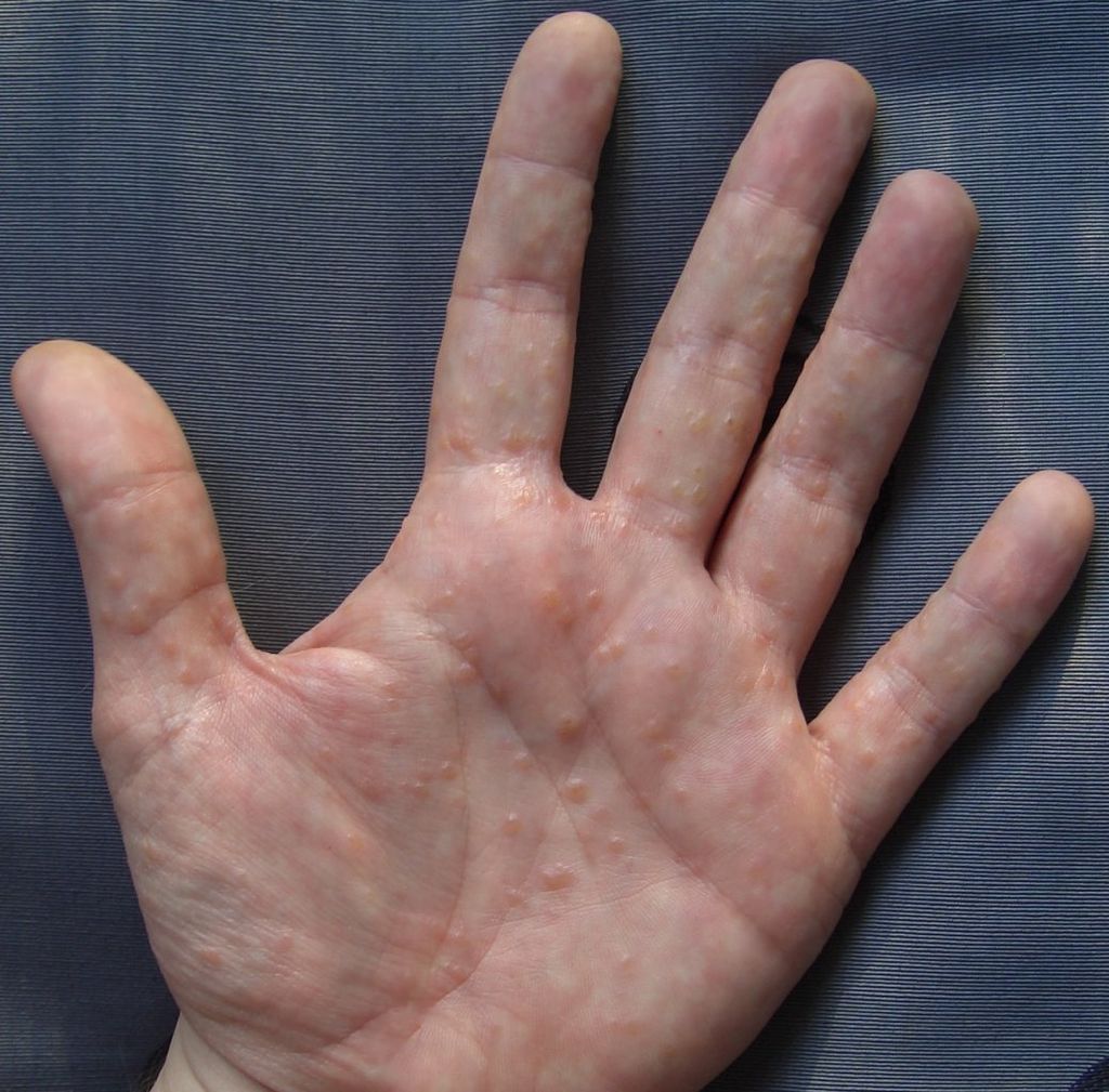 Já ouviu falar sobre disidrose? Entenda sobre essa condição dermatológica