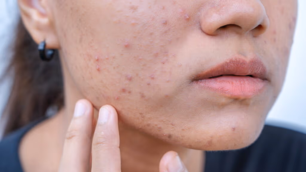 Cinco passos práticos para melhorar a saúde da pele e evitar acne
