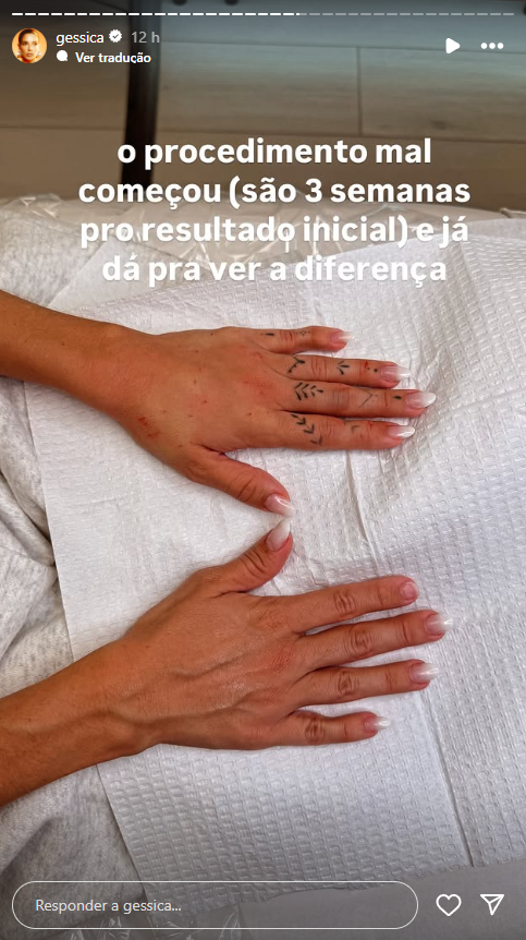 Gkay surpreende ao revelar nova harmonização