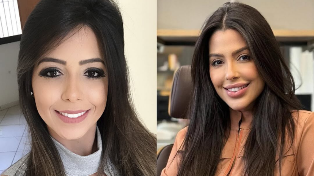 Ex-BBB surpreende ao mostrar antes e depois de procedimentos estéticos