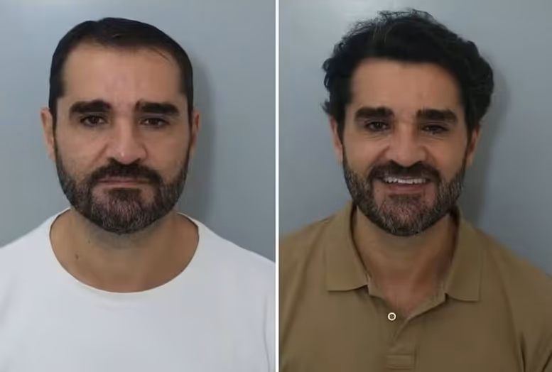 Marcelo Cosme mostra resultado de transplante capilar