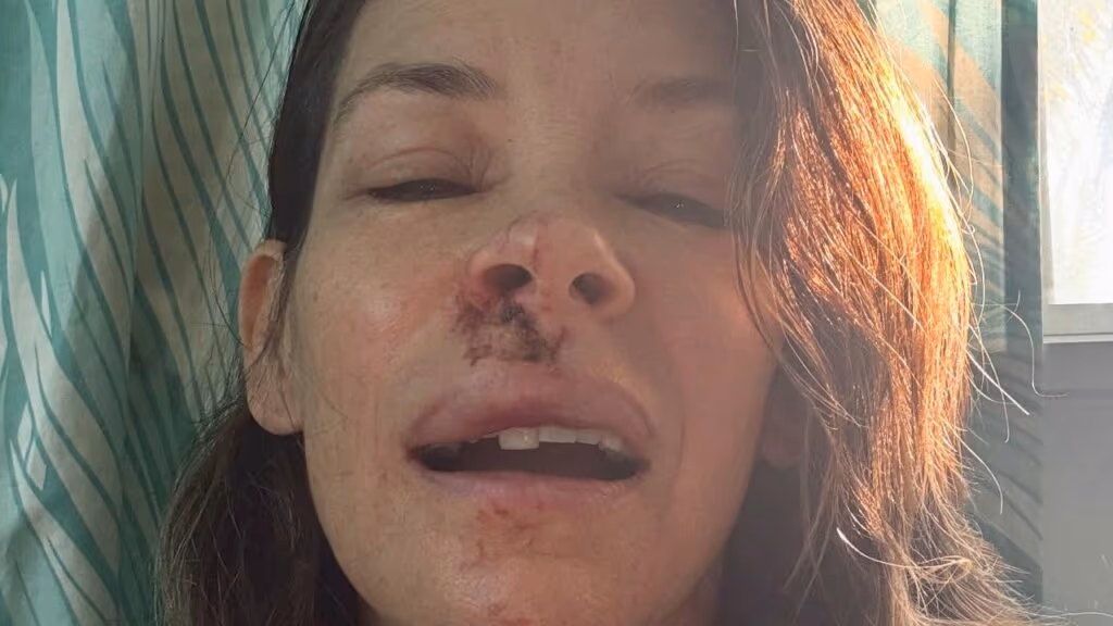 Atriz da Marvel sofre acidente e mostra rosto machucado