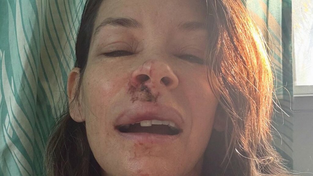 Atriz da Marvel sofre acidente e mostra rosto machucado