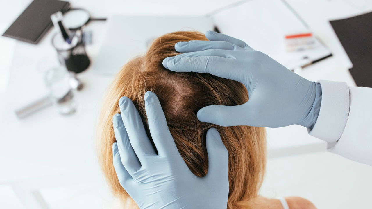 O xodó dos especialistas para lidar com caspa que virou tendência