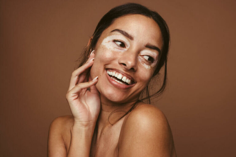 Entenda as causas e os tratamentos para o vitiligo