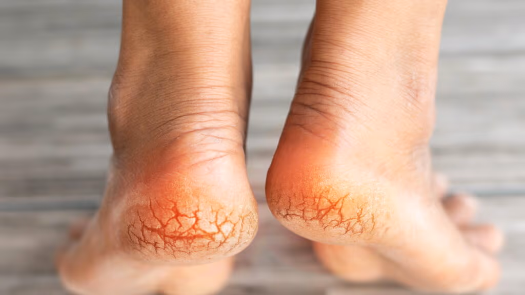 Este truque simples virou o queridinho de quem sofre com calcanhar rachado