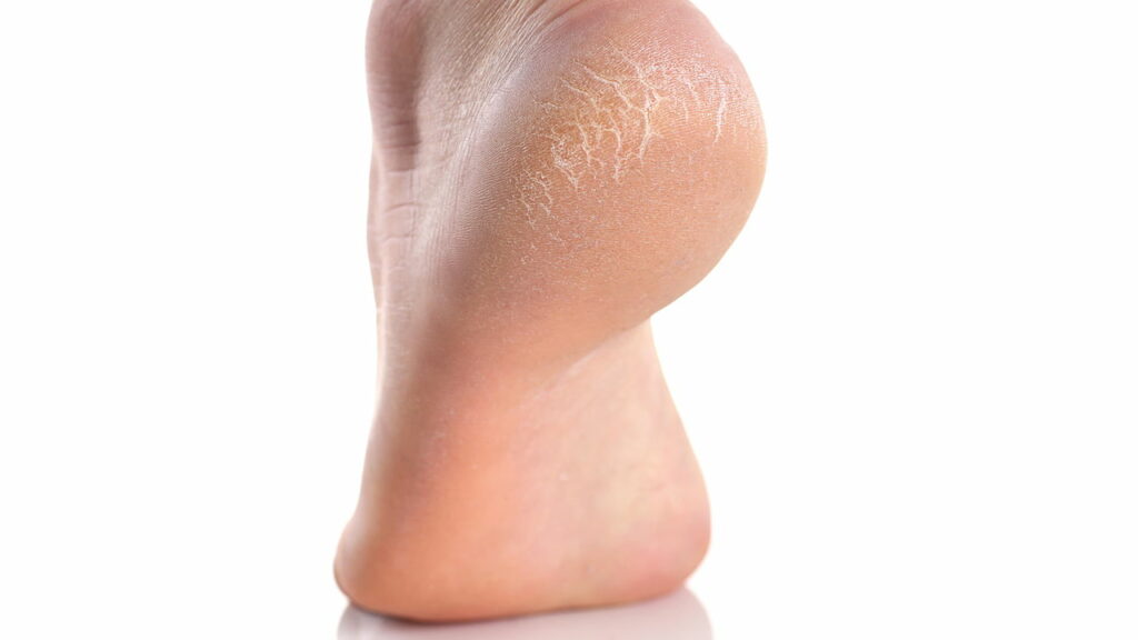 Este truque simples virou o queridinho de quem sofre com rachaduras nos pés