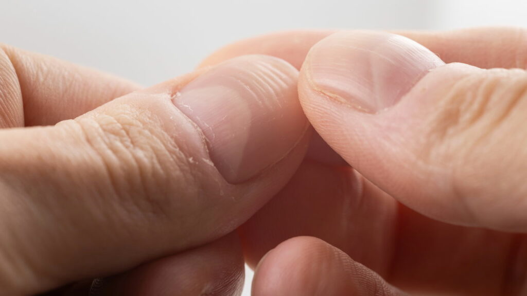 Unhas estriadas podem revelar deficiências nutricionais