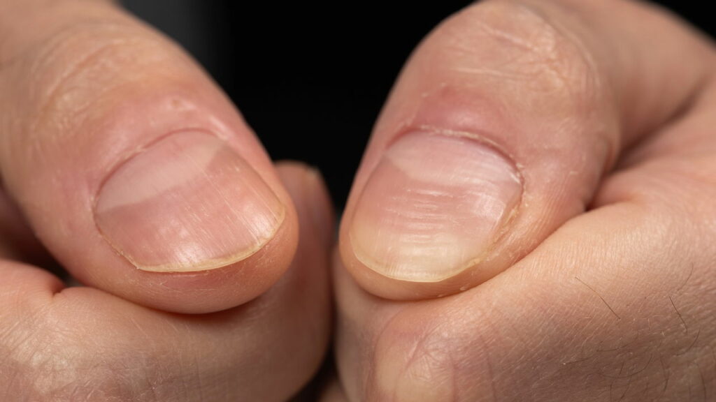 Unhas estriadas podem revelar deficiências nutricionais