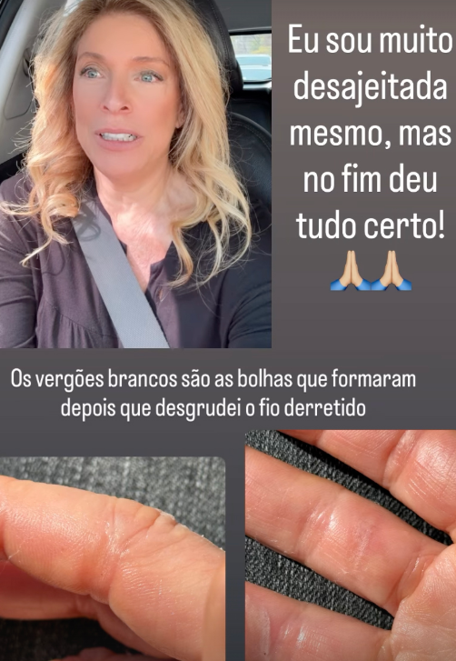Sacha Chryzman, mãe de Fabiana Justus, sofre acidente doméstico