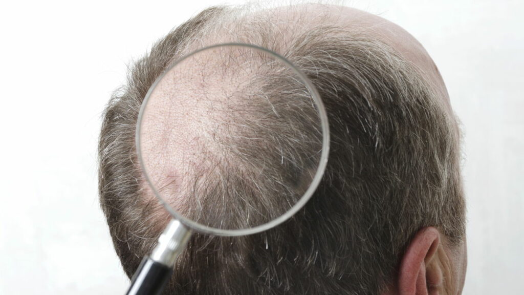 Tchau careca! Cientistas descobrem como ressuscitar o cabelo