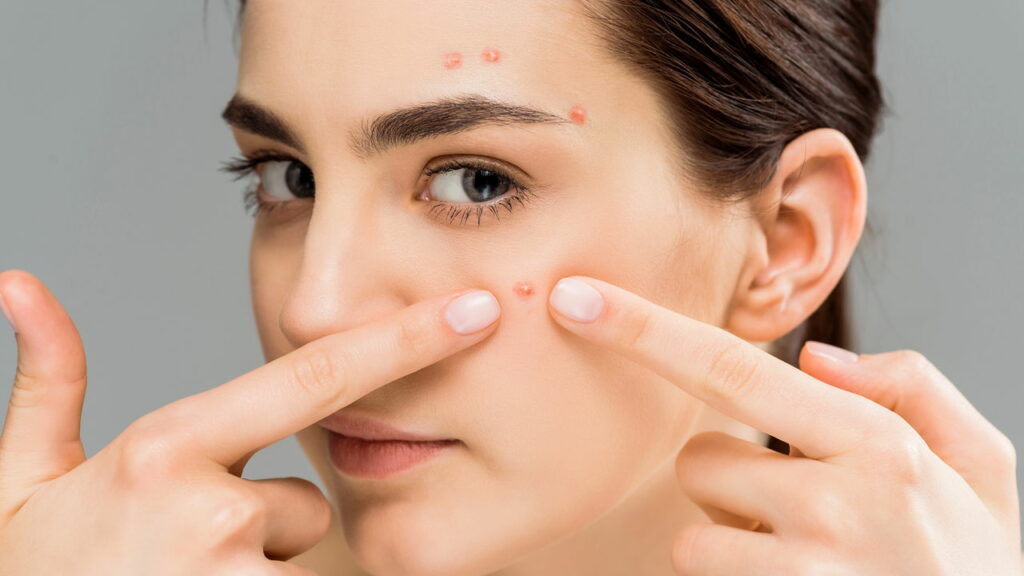Cinco passos práticos para melhorar a saúde da pele e evitar acne