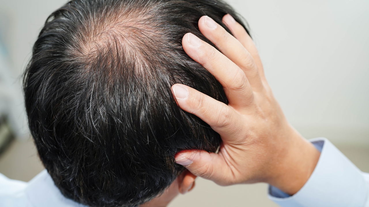 Milhares de homens estão freando a calvície com essa simples mudança