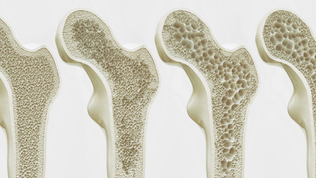 Cientistas descobrem técnica inovadora que pode reverter o avanço da osteoporose