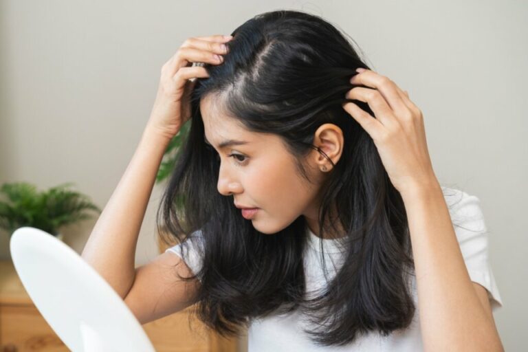 Veja as causas e os tratamentos para a alopecia areata