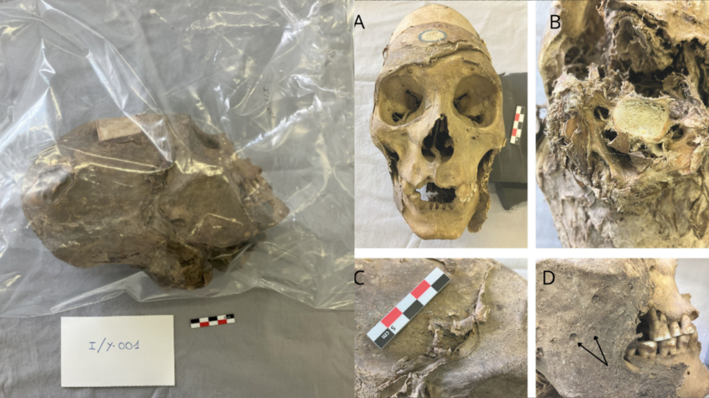 Crânio mumificado encontrado na América do Sul mostra como povos andinos dominavam a medicina antes dos europeus