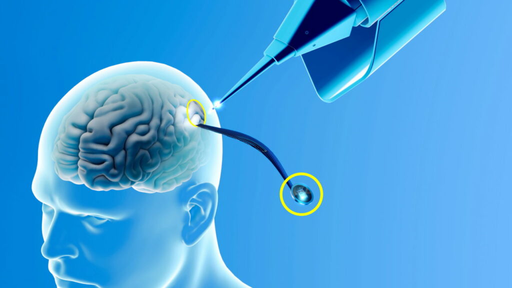 Pacientes tetraplégicos conseguiram controlar computador com o pensamento