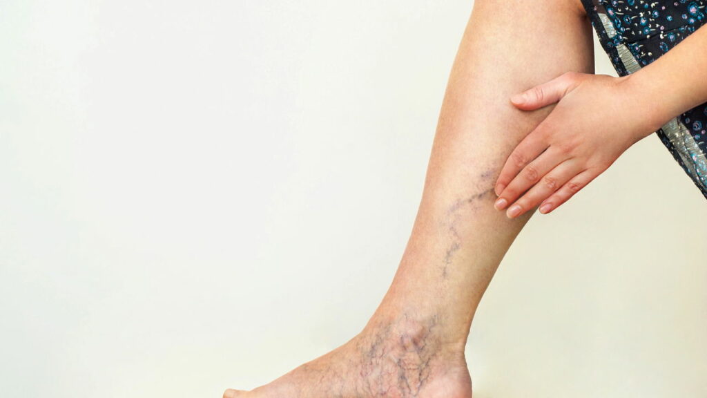 O que dizem especialista sobre fazer musculação tendo varizes?