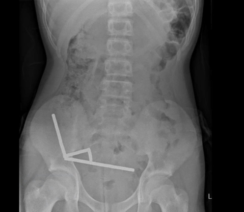 Jovem engole quase 100 ímãs e perde parte do intestino