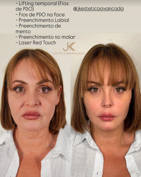 Atriz Gaby Spanic choca com resultado de harmonização facial