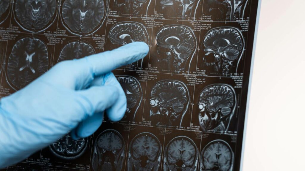 Redefinir o ritmo do corpo pode proteger o cérebro da doença de Alzheimer