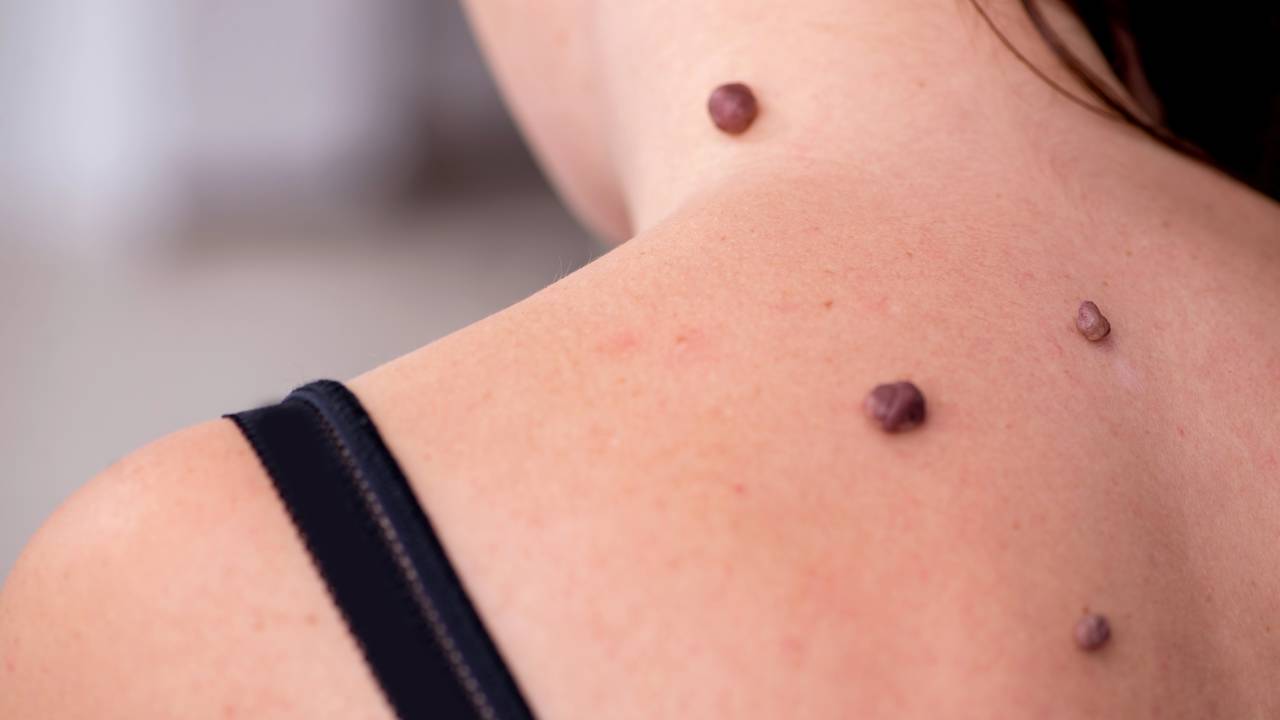 Uma verruga inocente pode esconder algo perigoso se não tratado logo