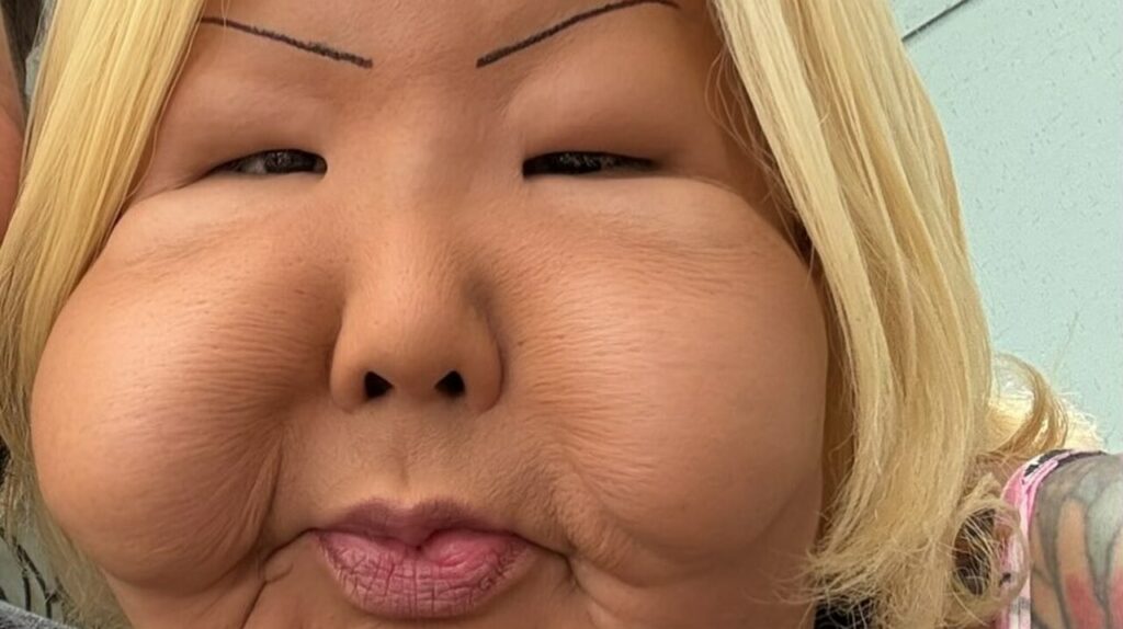 Juju do Pix passa por cirurgia de reconstrução facial