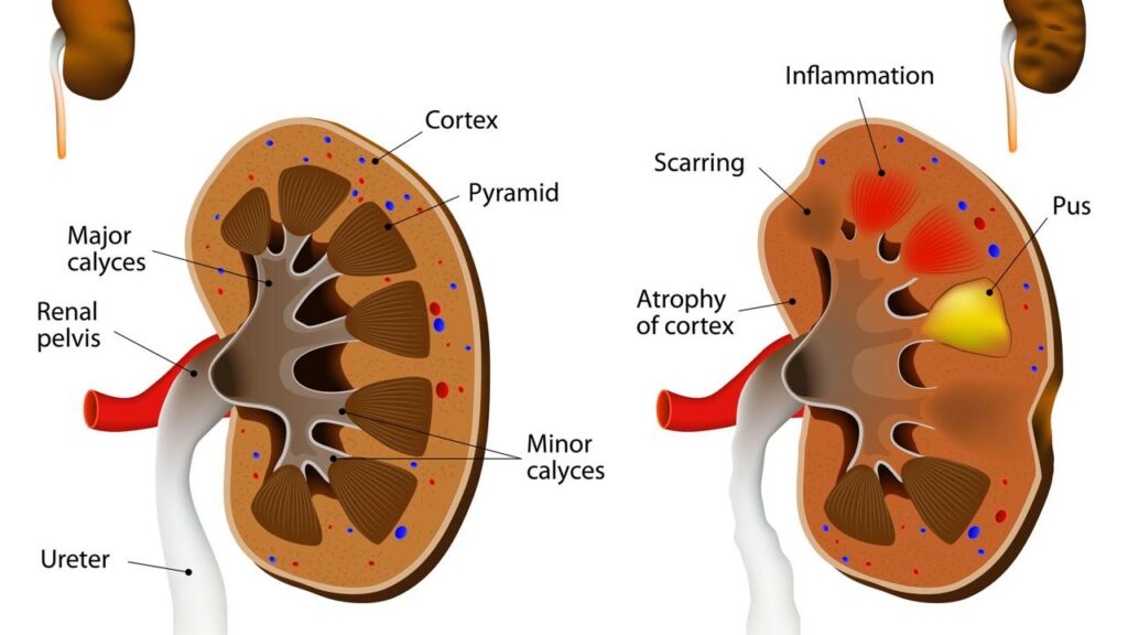 Ex-BBB é internada com infecção grave nos rins