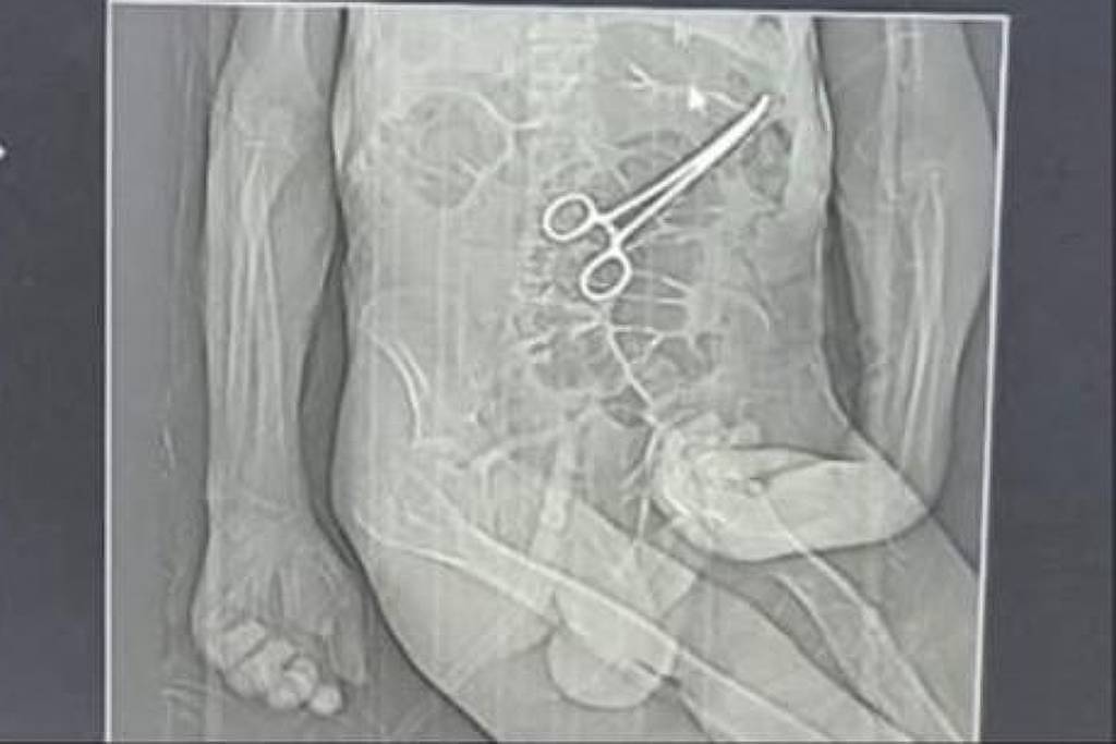 Hospital “esquece” pinça em corpo de idoso durante cirurgia em MG