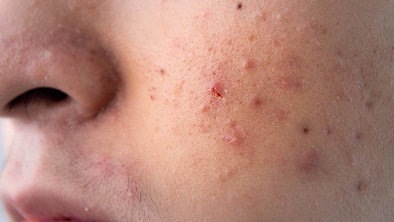 O alimento que limpa sua pele de dentro para fora e ajuda a reduzir espinhas sem cremes caros