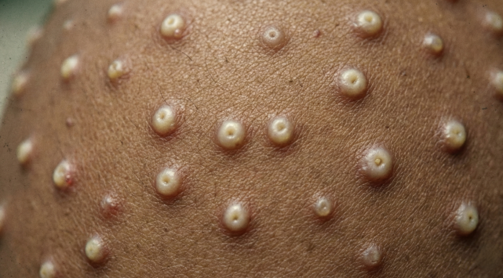 A infecção por varíola gerava pústulas cheias de pus, deixando manchas e marcas pelo corpo que se perpetuavam por toda a vida do infectado