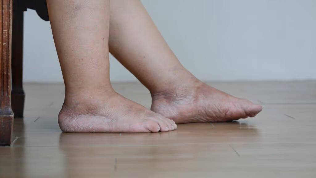 Como identificar se o inchaço na perna é só retenção ou sinal de algo grave mesmo sem sentir dor nenhuma