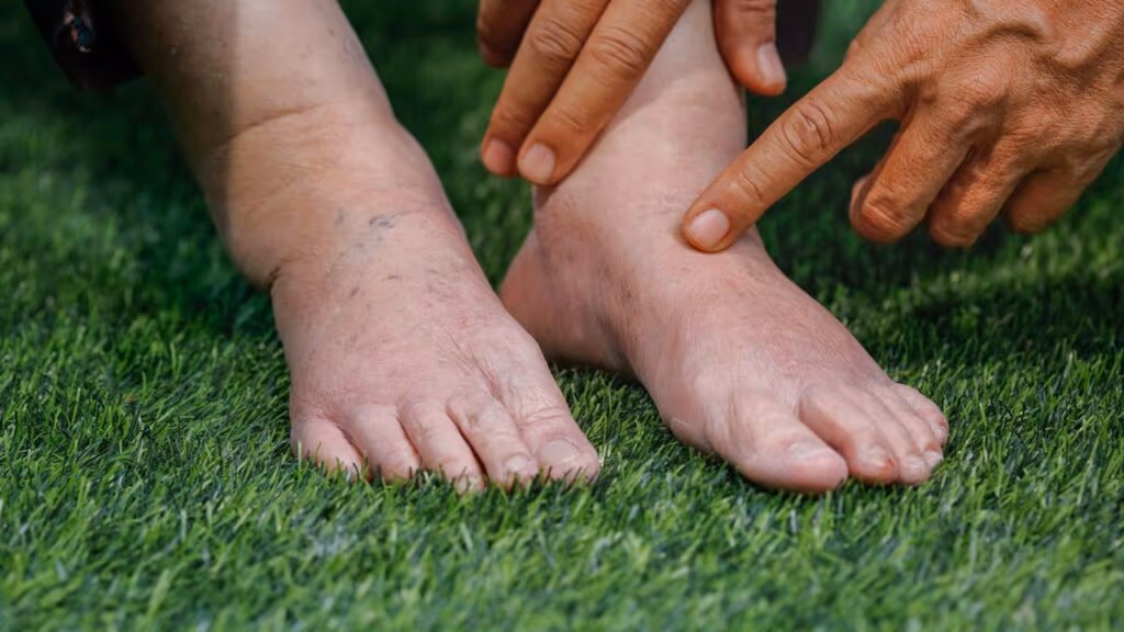 Por que o corpo incha mais no calor e o que fazer para evitar