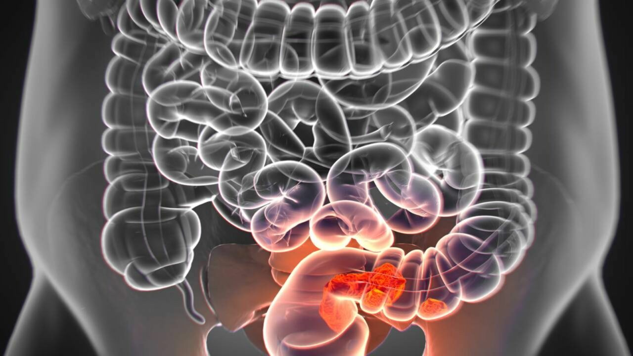 Quem tem menos de 50 anos precisa dar atenção a este tipo de tumor