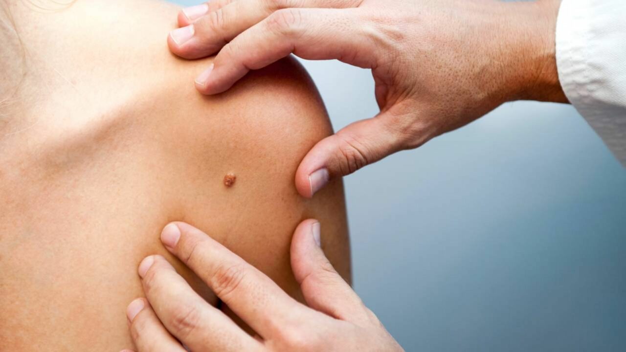 O que significa quando uma pinta muda de aparência segundo especialistas e por que isso merece atenção