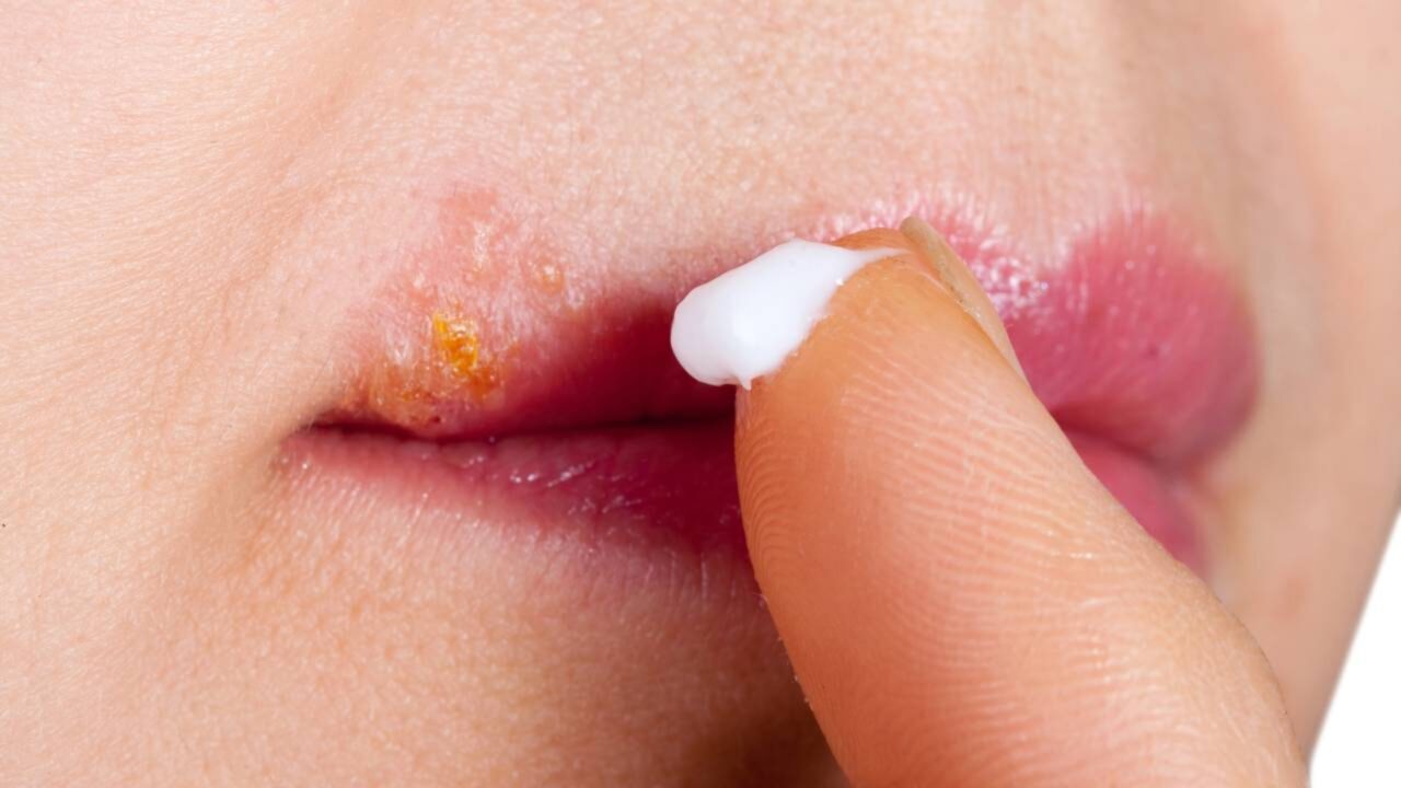 Vírus extremamente contagioso já atingiu 90% da população brasileira e mesmo assim ainda não tem cura