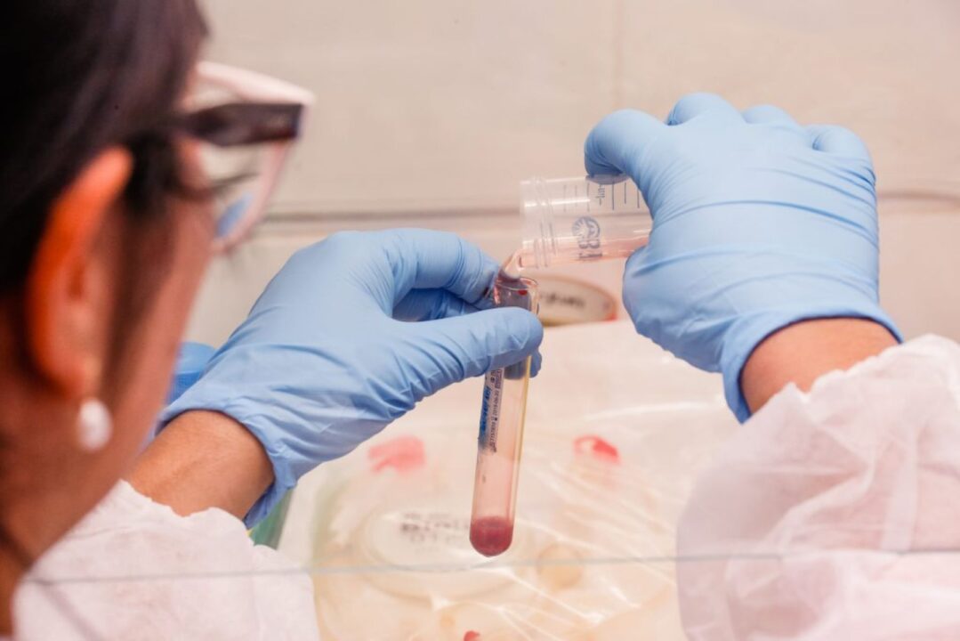 Combinação de IA e exame de sangue zera falhas no diagnóstico da hanseníase