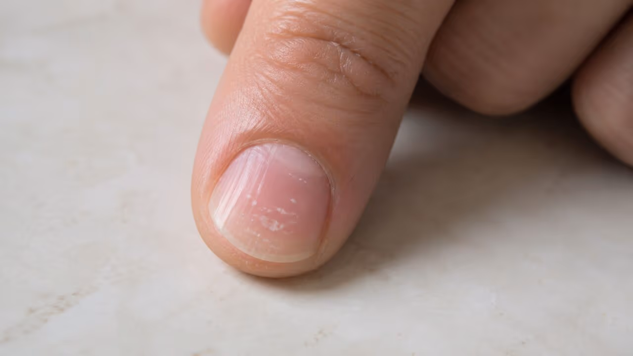 Manchas na unha indicam falta de cálcio ou esse é um dos mitos mais persistentes sobre o corpo?