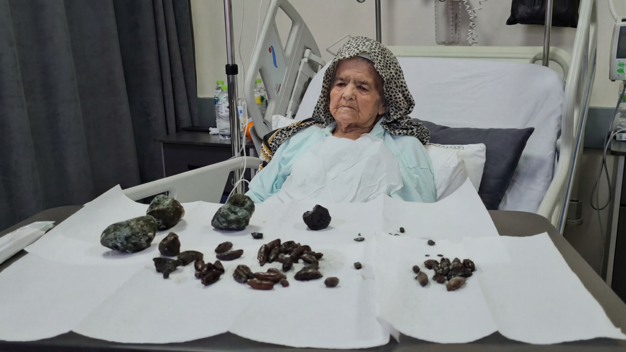 Uma idosa de 92 anos precisou ser internada após fortes dores: os médicos encontraram  35 caroços de azeitona, 28 sementes de tâmara e 5 pedras formadas por acúmulo no estômago e intestinos