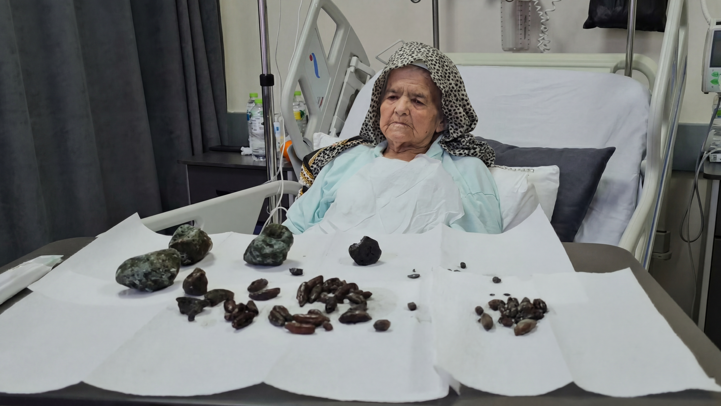 Uma idosa de 92 anos precisou ser internada após fortes dores: os médicos encontraram  35 caroços de azeitona, 28 sementes de tâmara e 5 pedras formadas por acúmulo no estômago e intestinos
