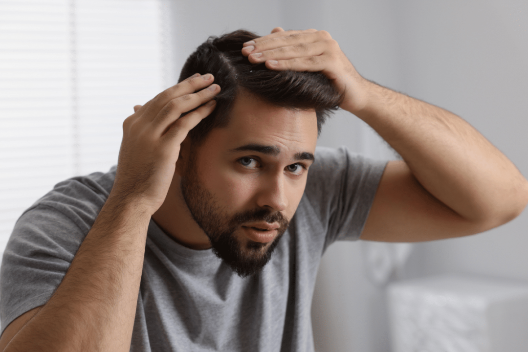 Eflúvio telógeno: veja a causa da queda de cabelo após infecções e o que fazer