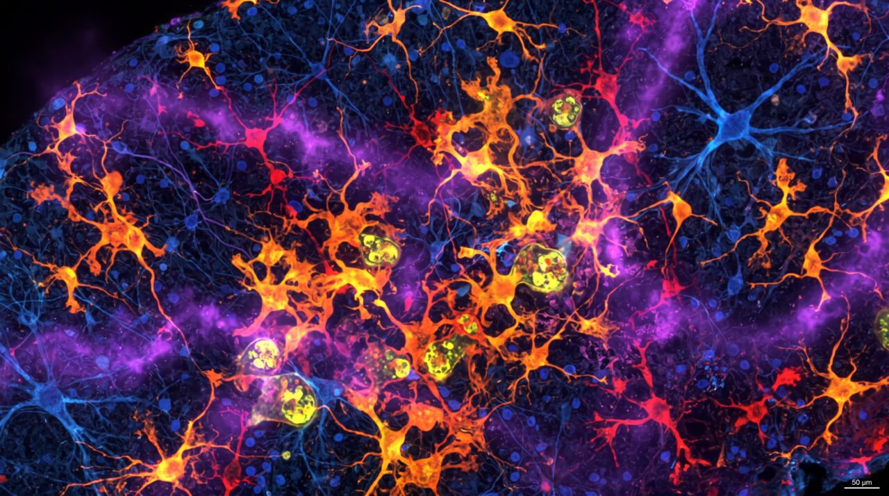 O álcool não afeta apenas os neurônios; ele induz células de defesa a destruir a matriz estrutural do cérebro, revela estudo